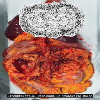 Circumferential Carcinoma of Transverse Colon